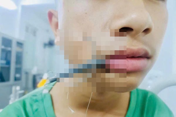 Nghệ An: Kịp thời cứu bé trai bị lưỡi câu cắm sâu vùng mặt
