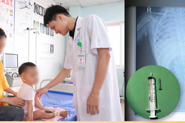 Cứu bé 21 tháng tuổi nuốt đinh vít, thoát nguy cơ thủng tiêu hóa