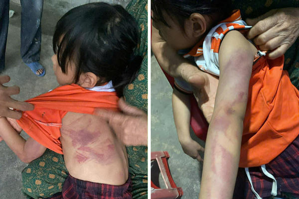 Hà Tĩnh: Nhà trường xin lỗi sau vụ học sinh lớp 2 bị bạn cùng lớp đánh bầm tím