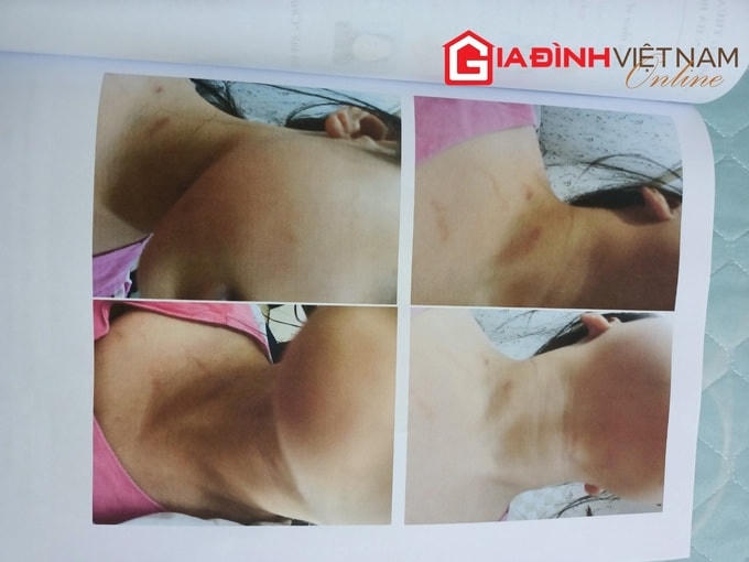 Những vết thương bầm tím trên cơ thể cháu H.A được phát hiện trong thời gian ở với bố dượng và mẹ đẻ.