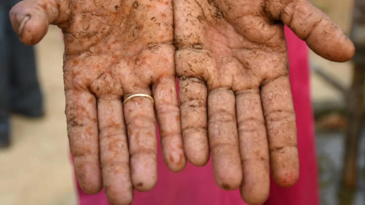 Các vấn đề về da như dày sừng là một trong những triệu chứng của nhiễm độc thạch tín. Ảnh: CNA.
