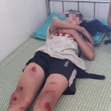 Một trong 2 học sinh bị thương phải nhập viện cấp cứu.