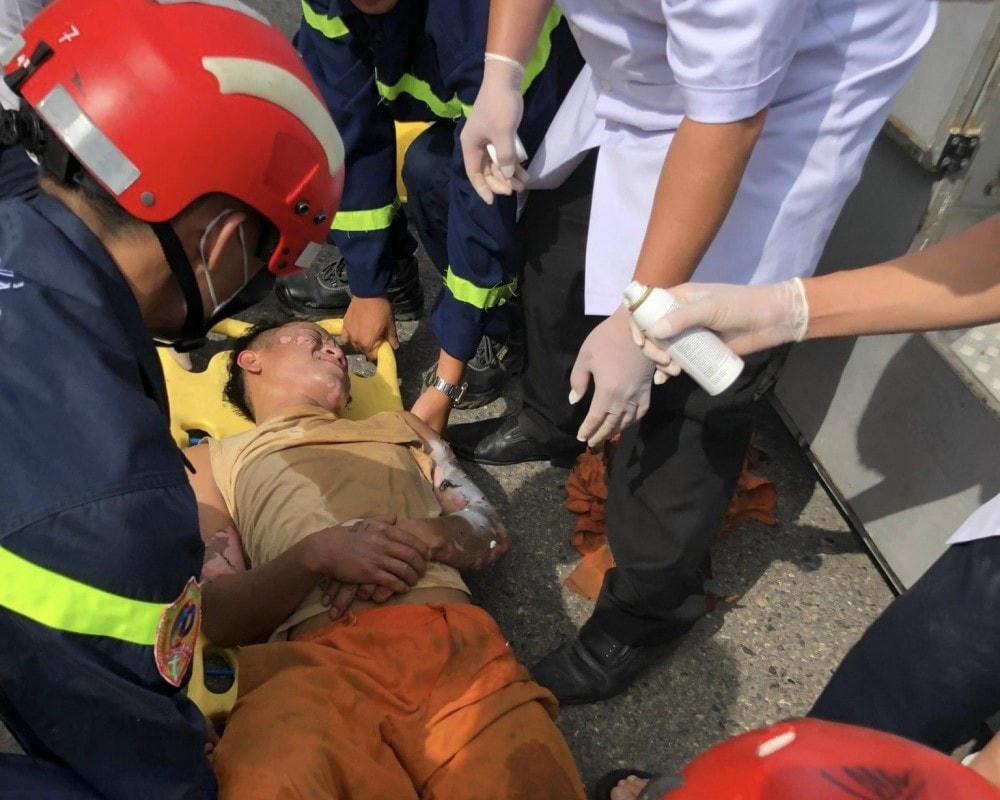 Anh N.V.Q. bị bỏng nặng nhiều vị trí trên cơ thể.