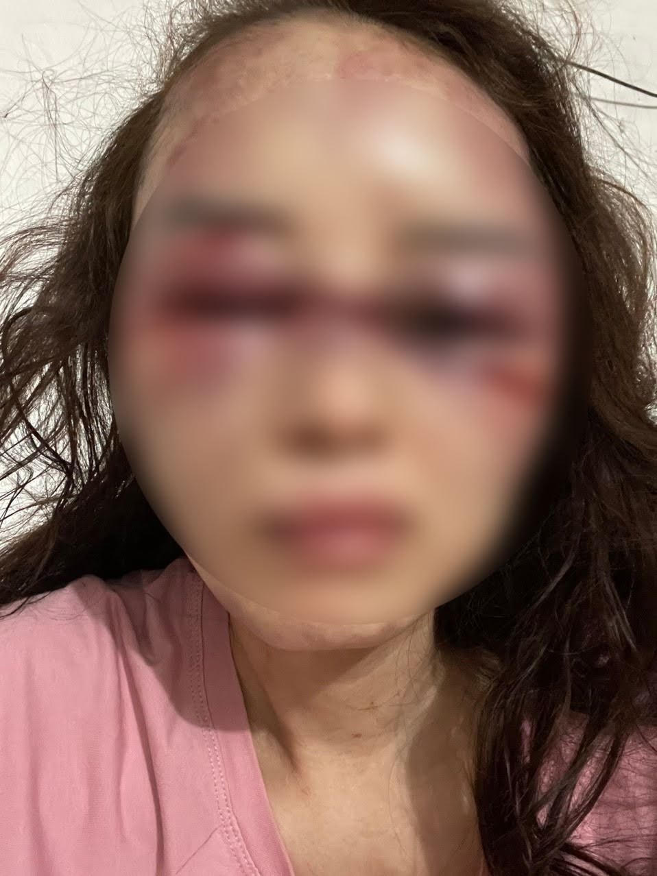 Gương mặt bầm dập vết thương mà chị V. cho rằng bị nhân tình đánh trong tối 21/8.