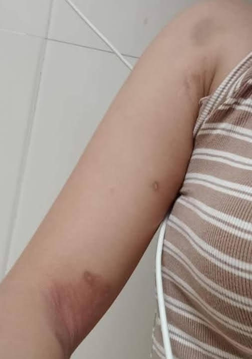 Những vết bầm tím trên cơ thể chị Q. mà người nhà cho rằng do bị bạo hành.
