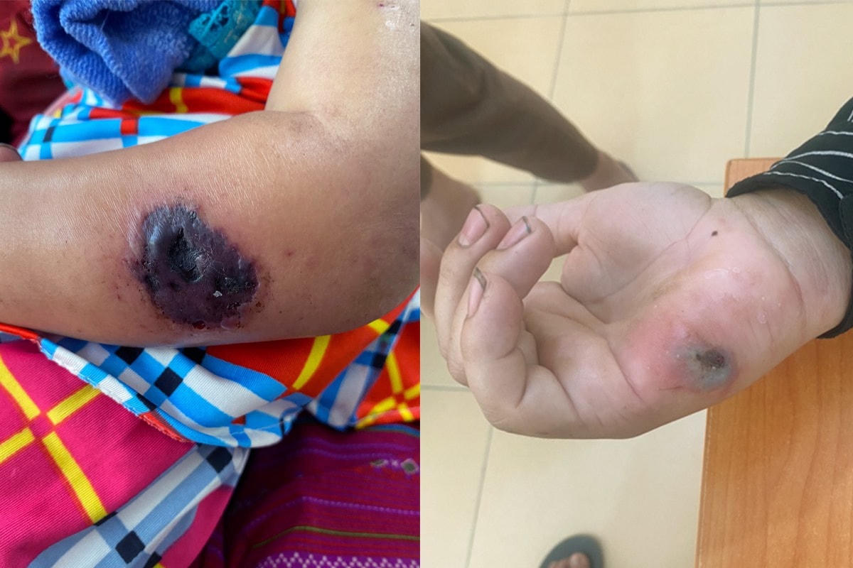 Một bệnh nhân mắc bệnh than tại Điện Biên. Ảnh CDC Điện Biên.