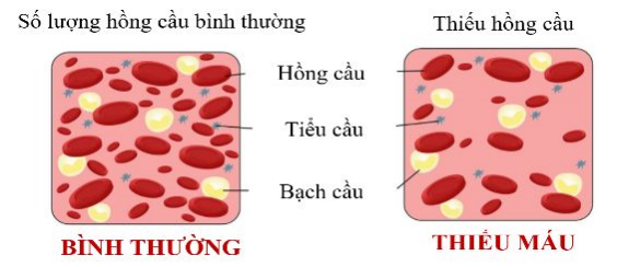 Thiếu máu (huyết không đủ) - thể chất huyết hư.