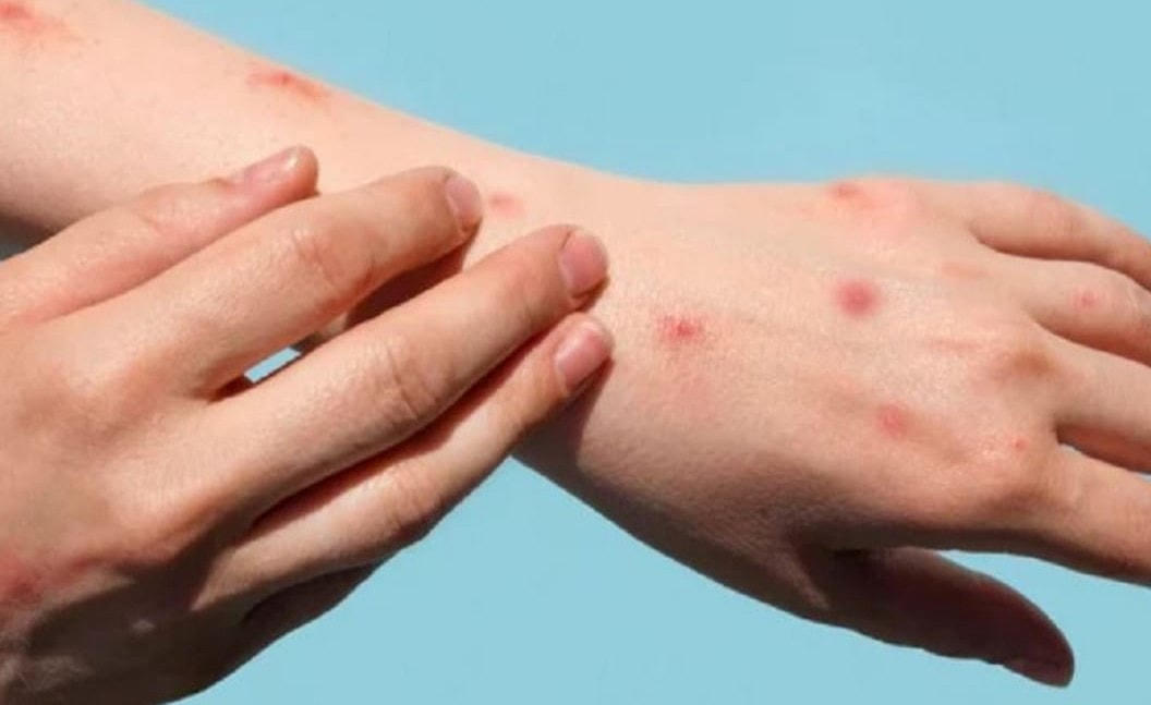 Việt Nam ghi nhận 2 trường hợp mắc bệnh đậu mùa khỉ từ nước ngoài trở về.