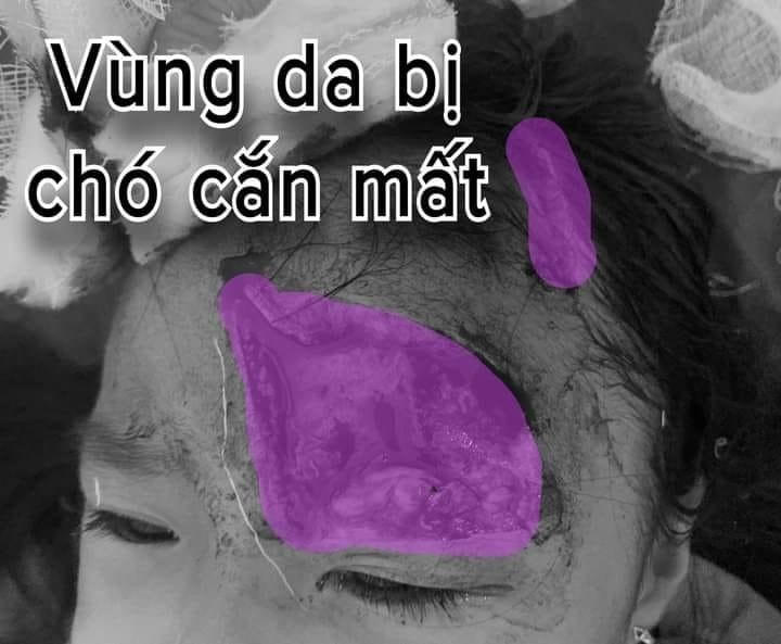 Cháu V. được đưa vào nhập viện trong tình trạng da vùng trán, quanh mắt trái bị cắn mất một mảng da to chừng 8x6cm.