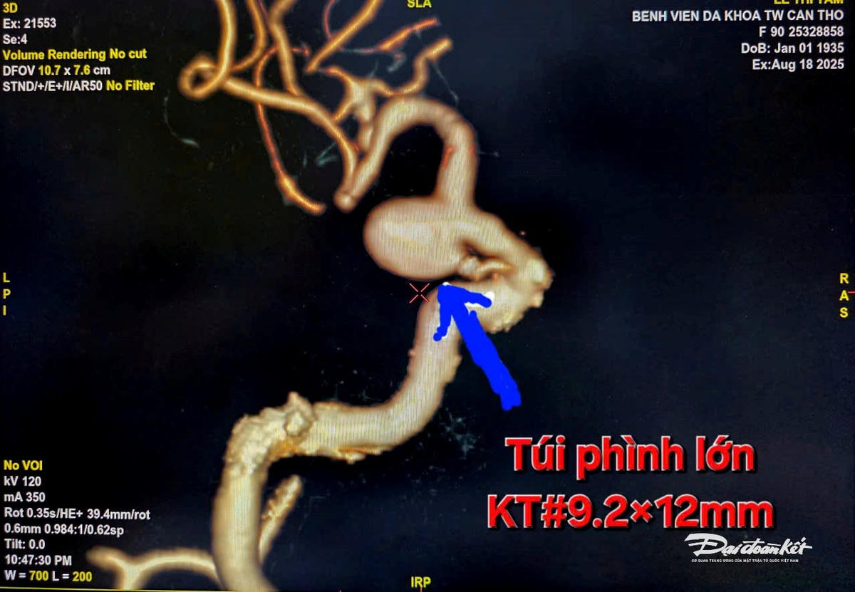 Túi phình mạch máu nảo kích thước lớn trước can thiệp. Ảnh NN.