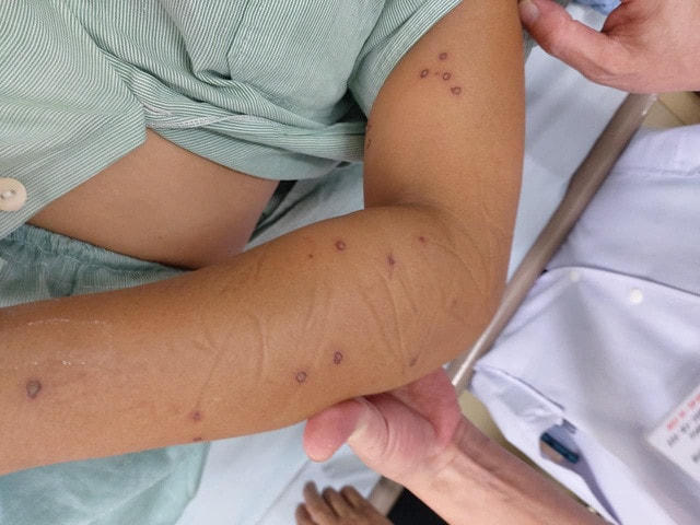 Bác sĩ kiểm tra các vết ong đốt trên cánh tay bệnh nhân. Ảnh: TL.