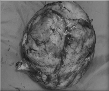 Khối u kích thước lớn được y, bác sĩ lấy ra ngoài.  