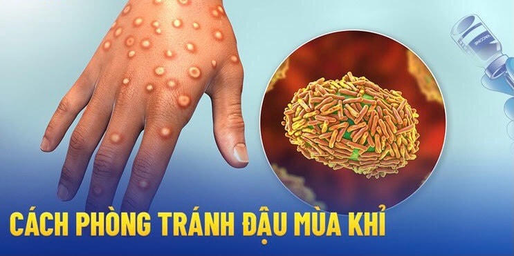 Cách tốt nhất để phòng, tránh bệnh đậu mùa khỉ là đeo khẩu trang, rửa tay sát khuẩn và có lối sinh hoạt lành mạnh.
