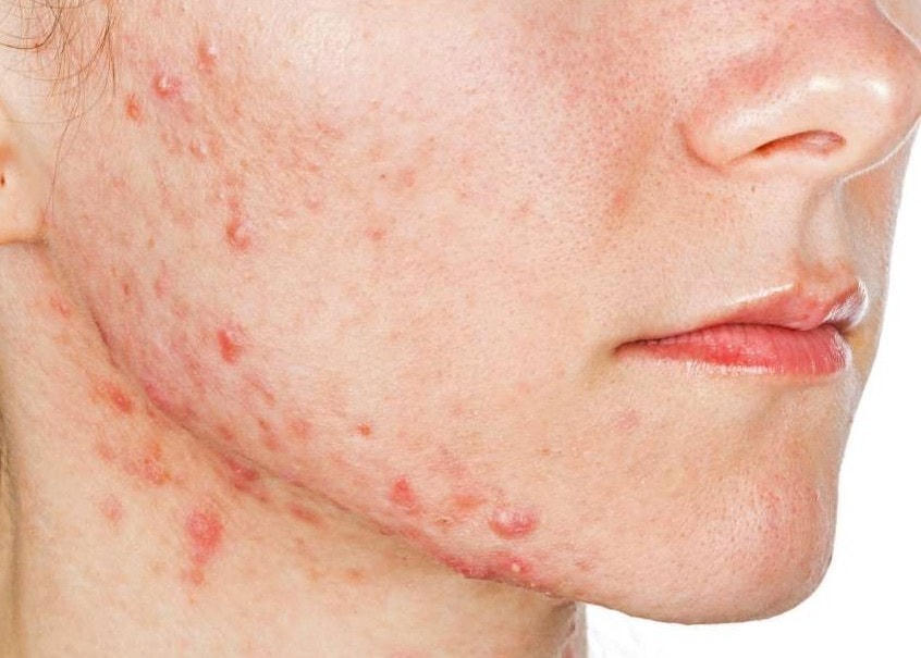 Mụn trứng cá do thuốc khác với mụn trứng cá thông thường.