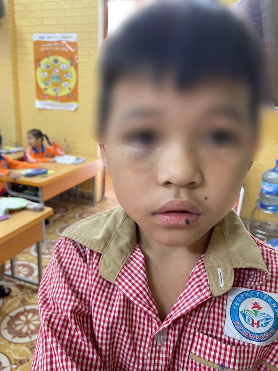 Người bé B. có nhiều vết thương bầm tím trên cơ thể.