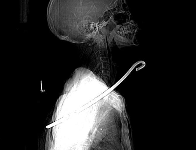 Bản chụp CT-Scan thanh sắt đâm thấu cổ bệnh nhân V.C.Đ.
