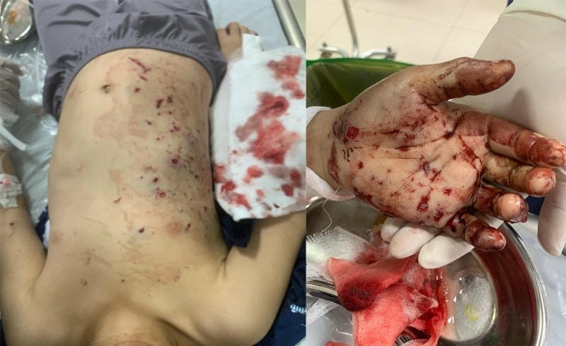 Hình ảnh các tổn thương của bệnh nhi sau nổ pin đồ chơi.