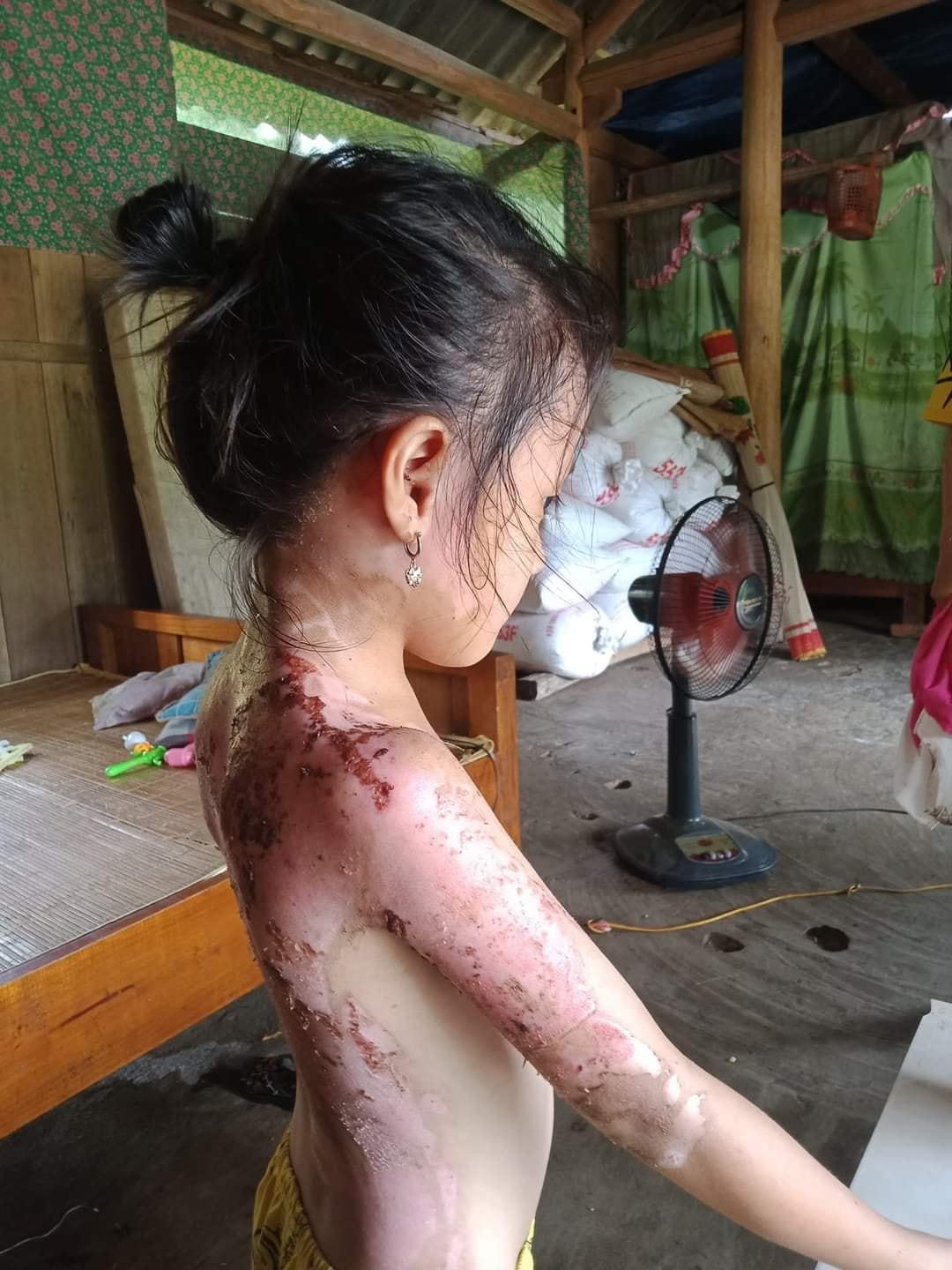 Hình ảnh cháu Dư bị bỏng nặng được chia sẻ lên mạng