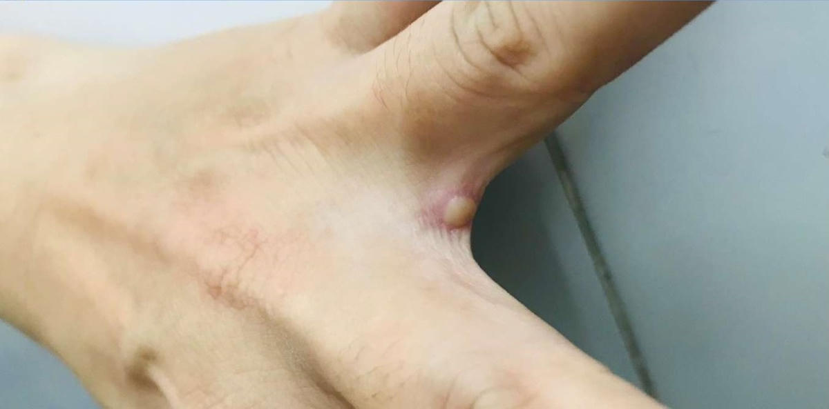 Bóng nước điển hình rải rác các vị trí khác nhau trên cơ thể người bệnh. Ảnh: Bệnh viện Bệnh nhiệt đới TP HCM.