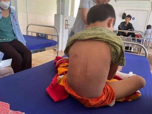 Vết bầm tím ở lưng do cha đẻ dùng thanh sắt đánh đập.