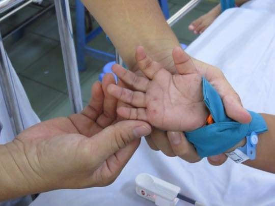 Hồng ban là biểu hiện điển hình của bệnh tay chân miệng.