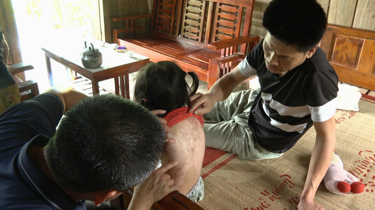 Dù 1 tháng đã trôi qua nhưng lưng và tay cháu Dư vẫn chằng chịt vết sẹo