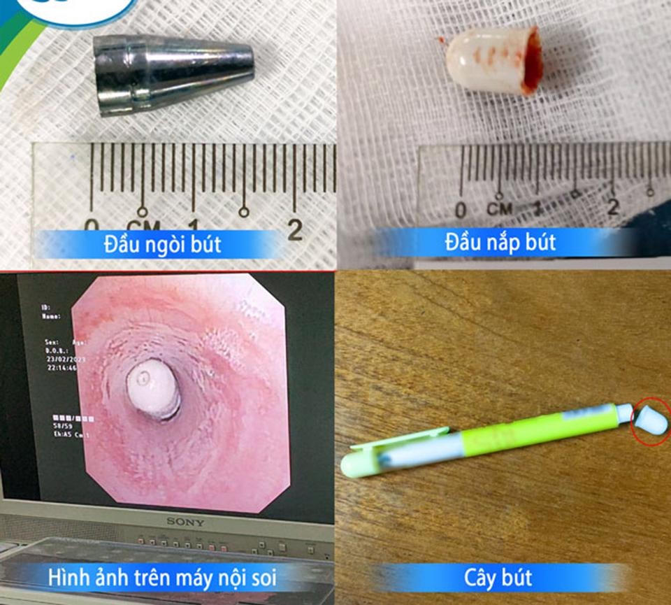Hình ảnh dị vật là đầu ngòi bút và đầu nắp bút được gắp ra từ khí quản bệnh nhi.