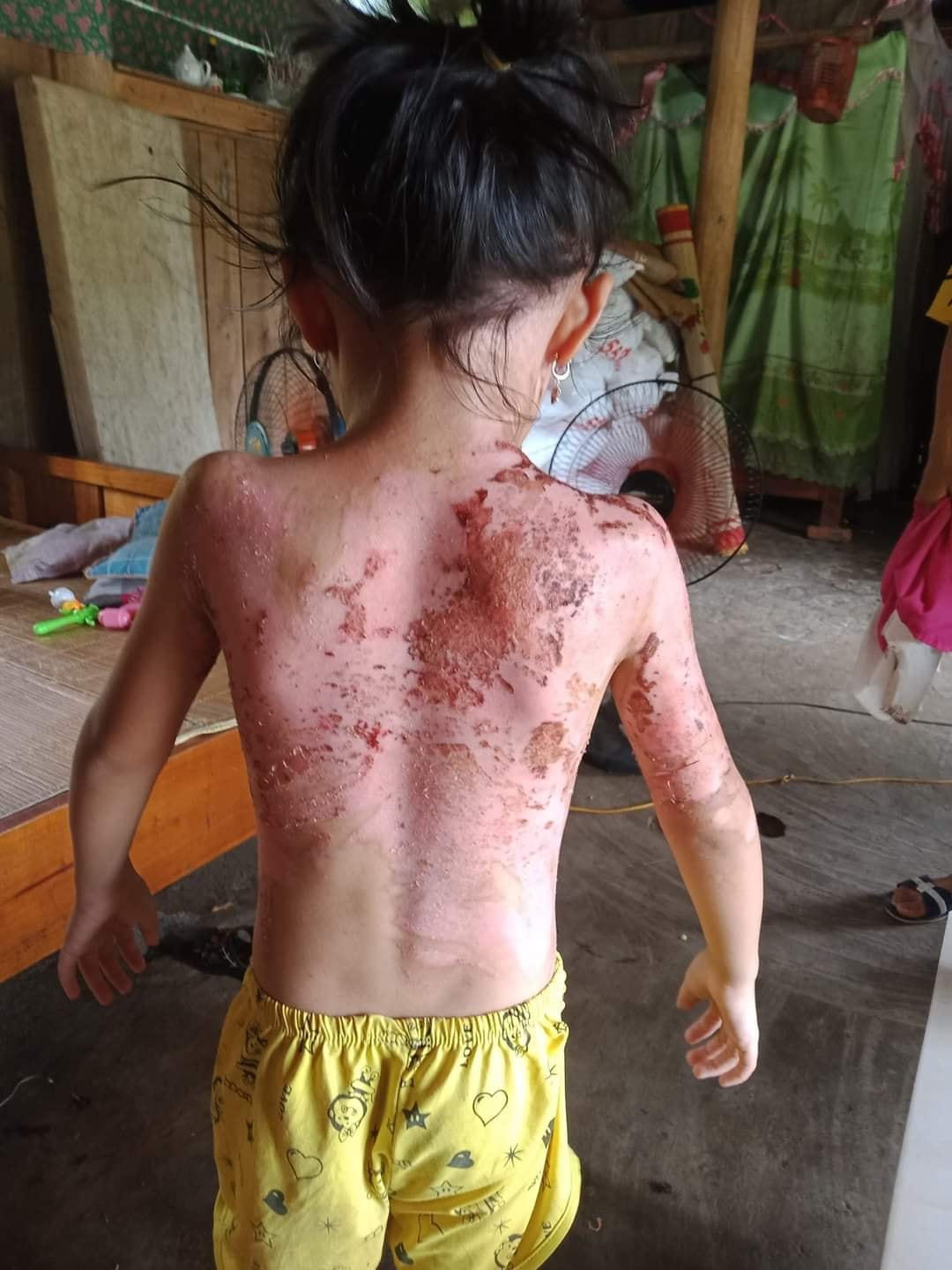Ngoài cháu Dư, còn có mẹ cháu và em gái cháu cũng bị bỏng nặng