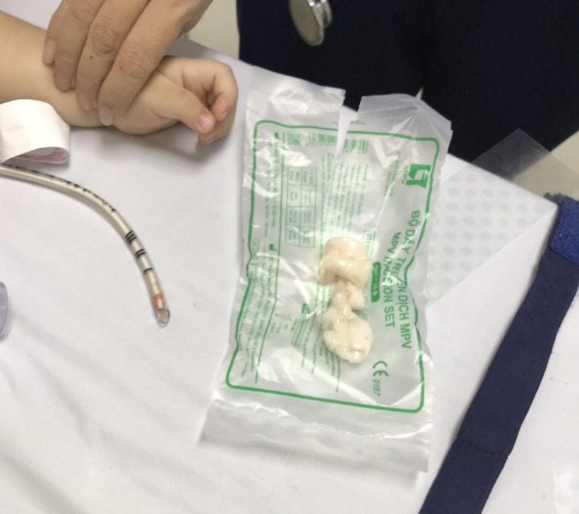 Dị vật thạch rau câu được lấy ra từ bệnh nhân.