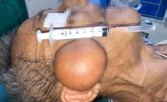 Khối u có kích thước lớn trên vùng mặt cụ ông T.Đ.T.
