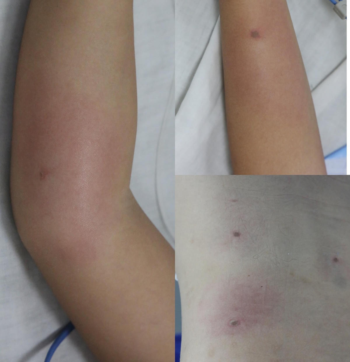 Vết ong đốt trên người bệnh nhi.