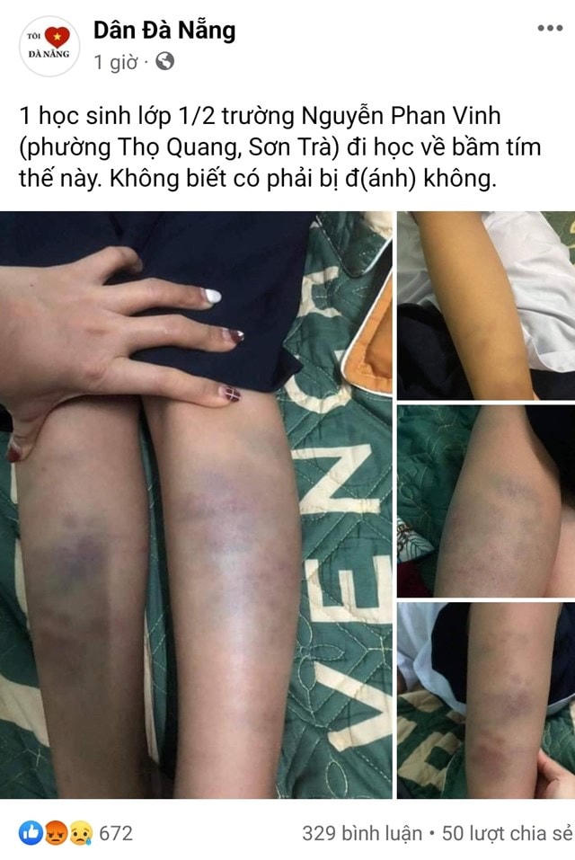 Hình ảnh đăng tải trên mạng xã hội trưa 6/10 về học sinh lớp 1 Trường Tiểu học Nguyễn Phan Vinh, nghi bị bạo hành.