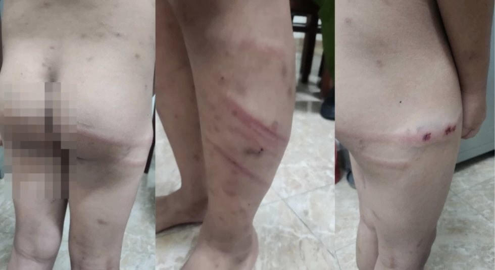 Những vết thương trên người cháu M. nghi do mẹ ruột và bạn trai gây ra. Ảnh: Xuân Nguyễn.