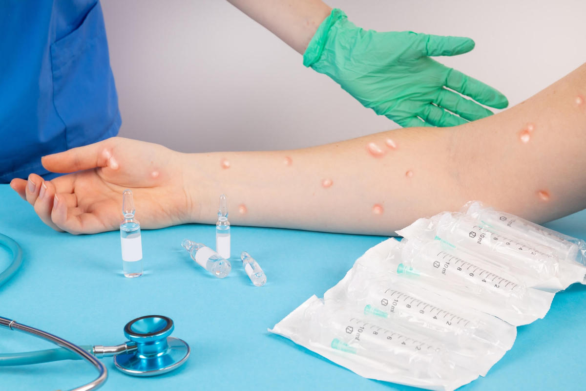 Hiện chưa có thuốc đặc hiệu, vaccine cho bệnh đậu mùa khỉ. Nguồn ảnh: Shutertock