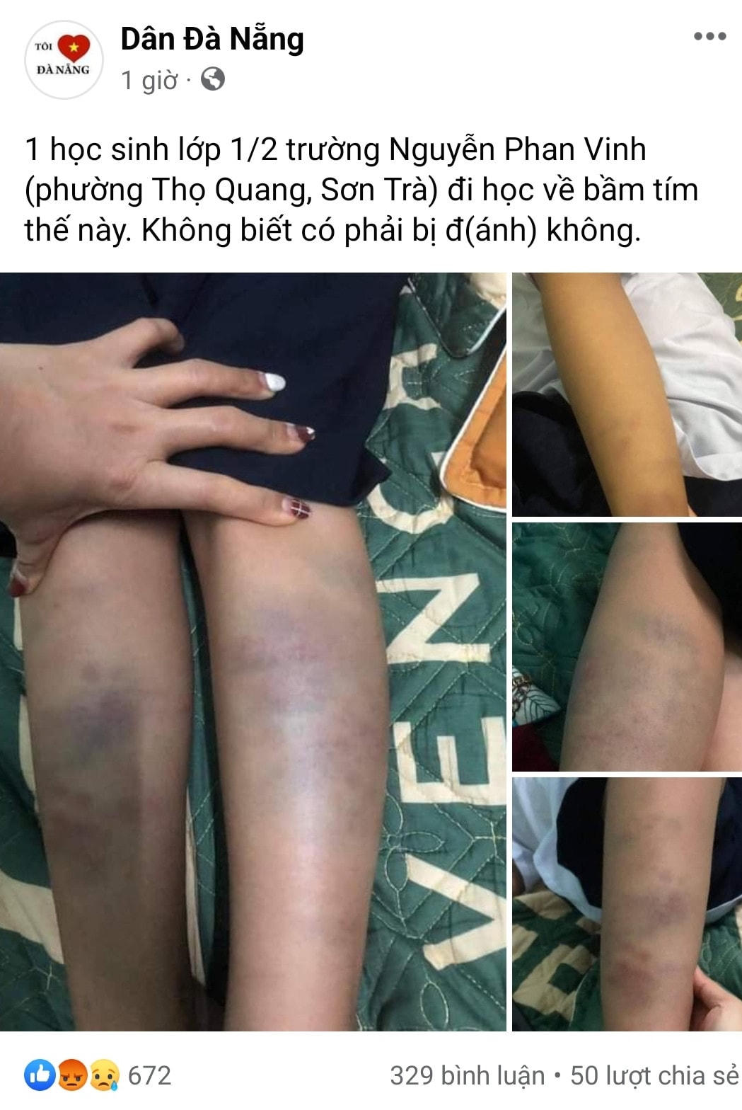 Vết bầm tím, nghi bị bạo hành trên chân học sinh lớp 1 Trường Tiểu học Nguyễn Phan Vinh.