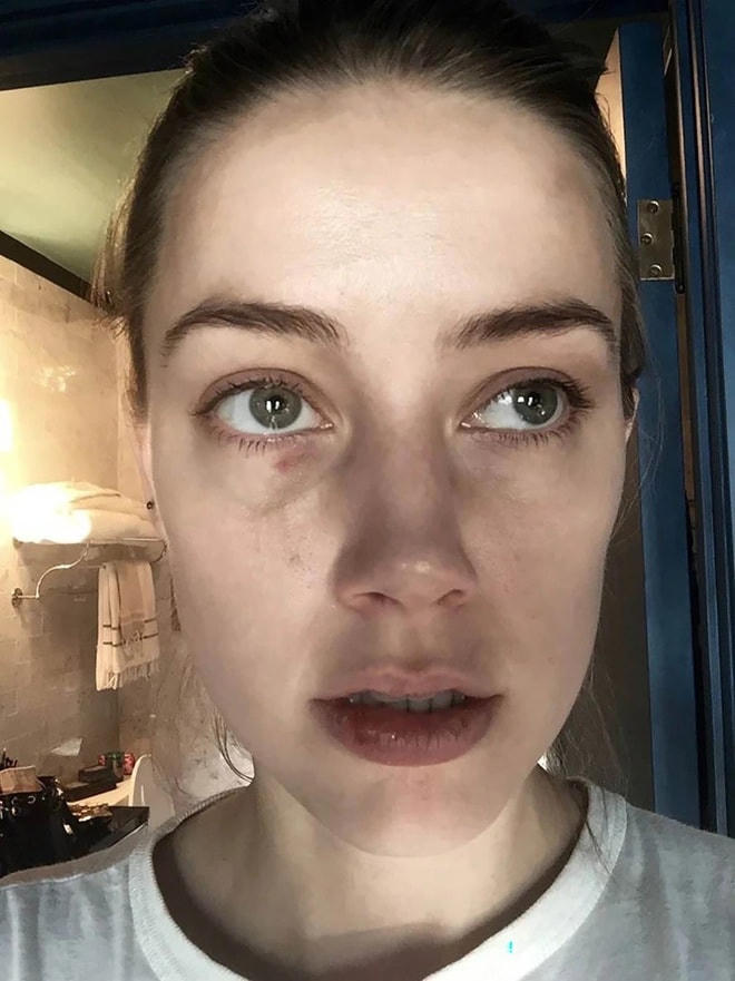 Amber Heard tung bằng chứng tố chồng bạo hành.