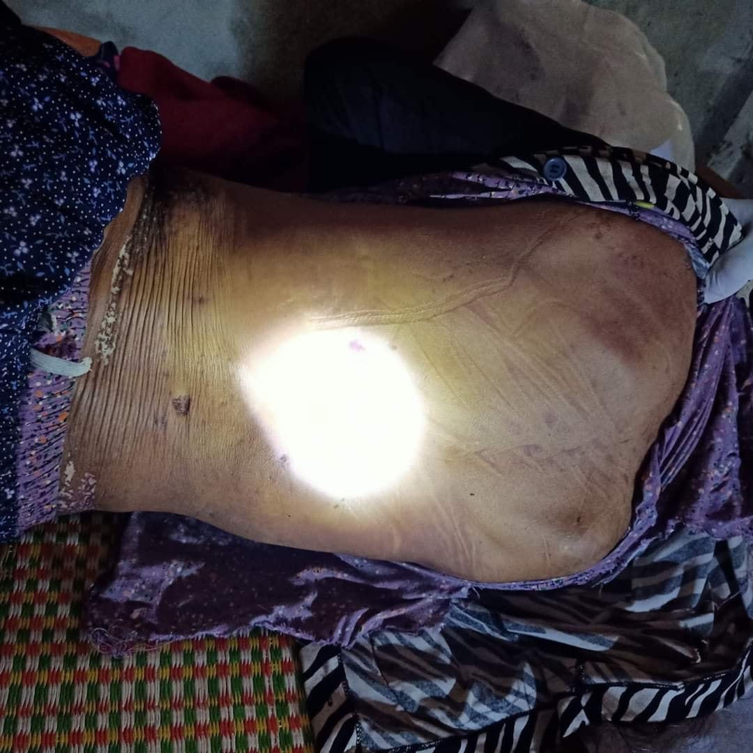 Trên cơ bà Vinh có nhiều vết bầm tím.