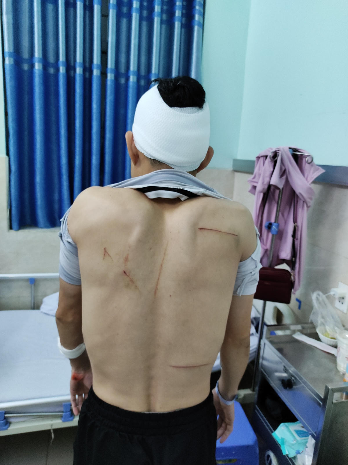 Anh Hiệu với những vết thương đã tạm ổn định.