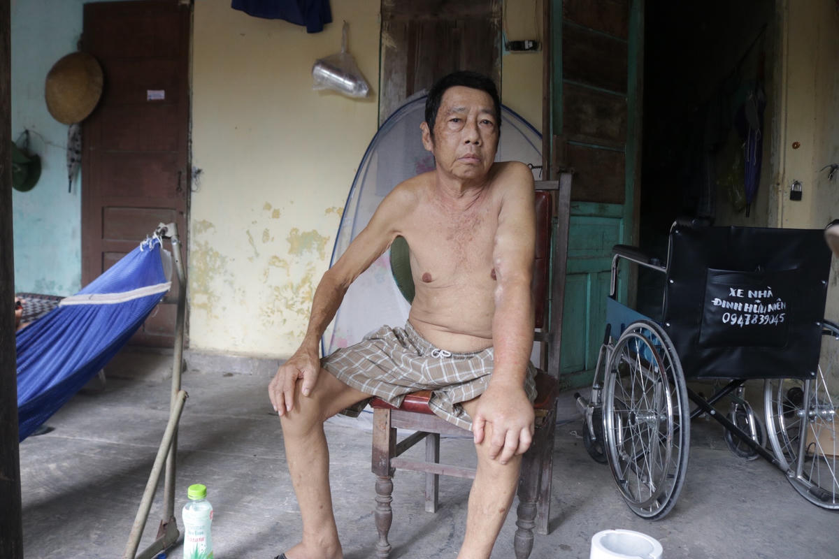 Khối u sau mỗi lần chạy thận để lại trên tay ông Nhiên.