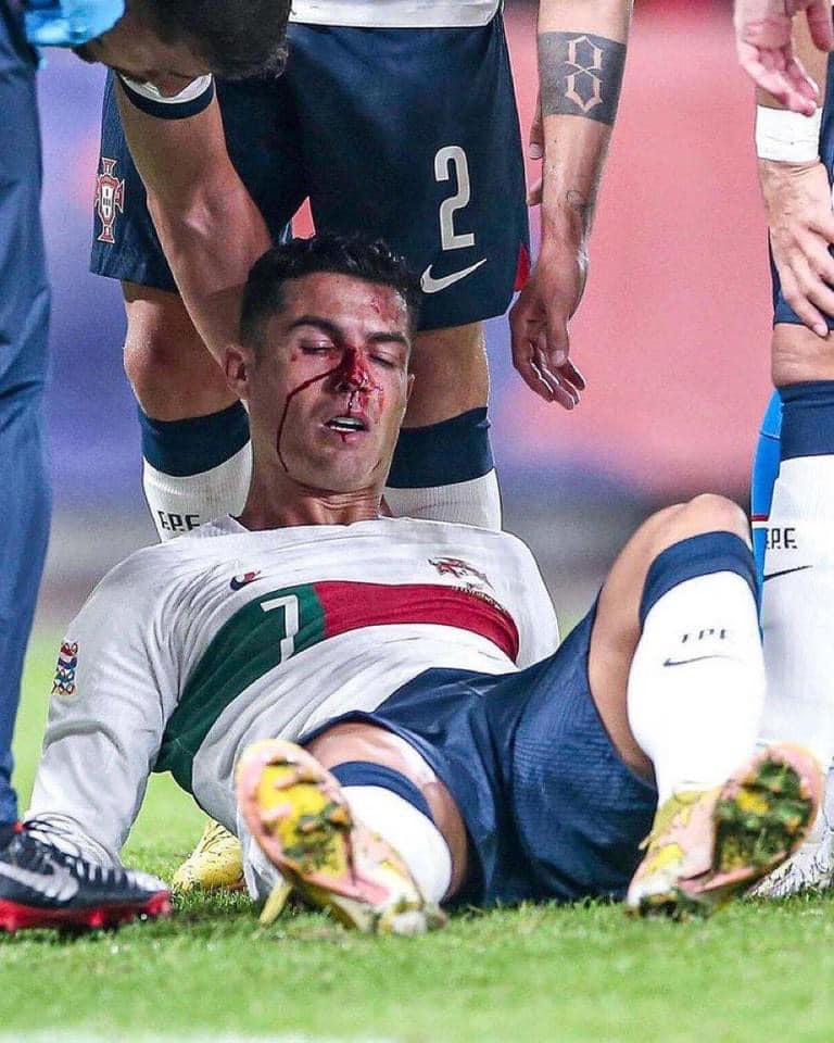 Ronaldo chảy máu ở vùng mặt.