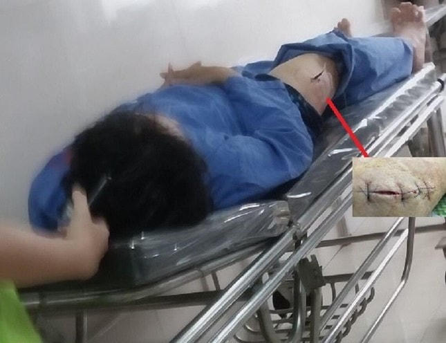 Vết đâm vào đùi ông G. sâu khoảng 4 cm.