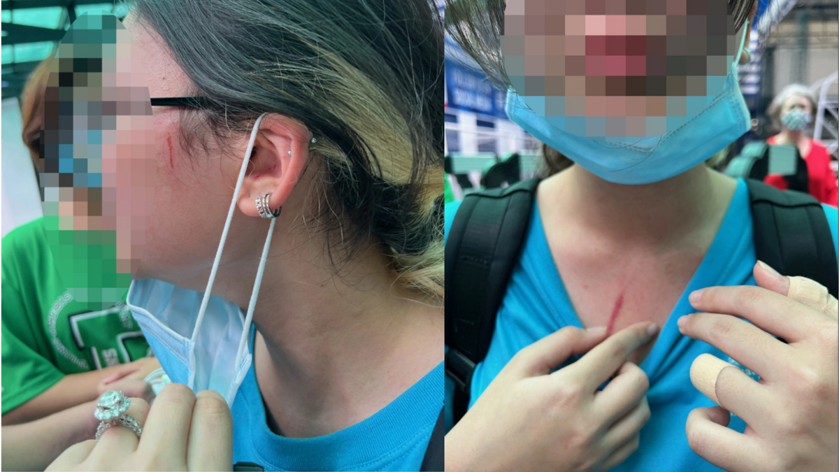Con gái chị T.H.T bị bầm tím và có vệt thương ở tay, mặt và trước ngực (Ảnh NVCC).