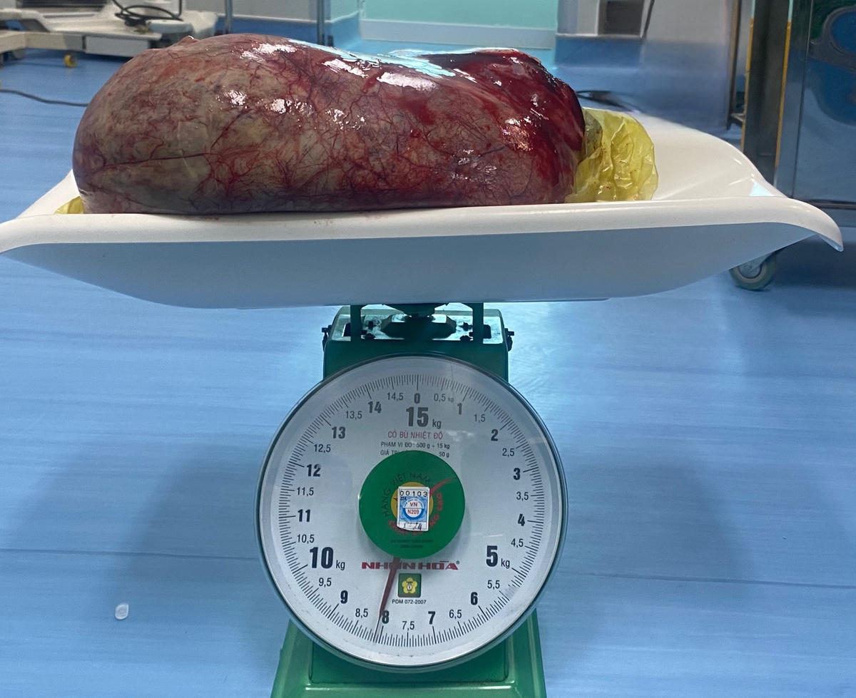 Khối u nặng 8,1kg được lấy ra từ người bệnh nhân Đ. 