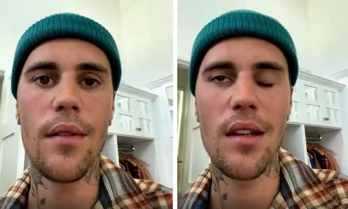 Justin không thể cử động một nửa bên mặt. Ảnh: Instagram.