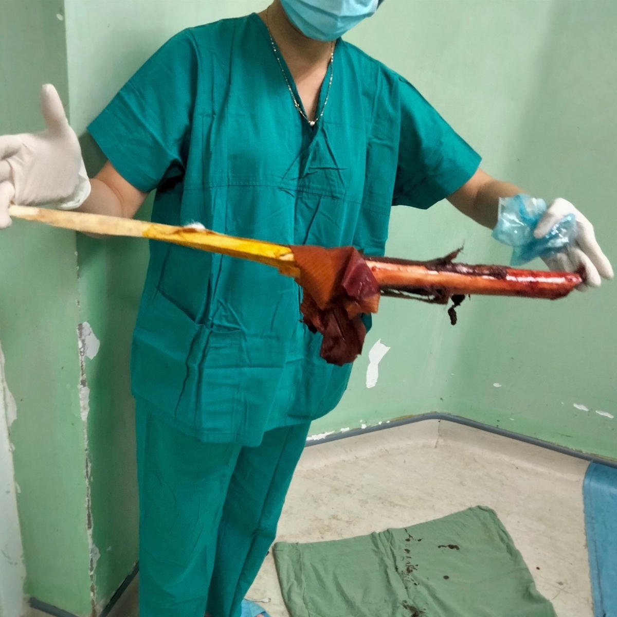 Khúc cây keo được phẫu thuật lấy ra từ ngực bệnh nhân S.