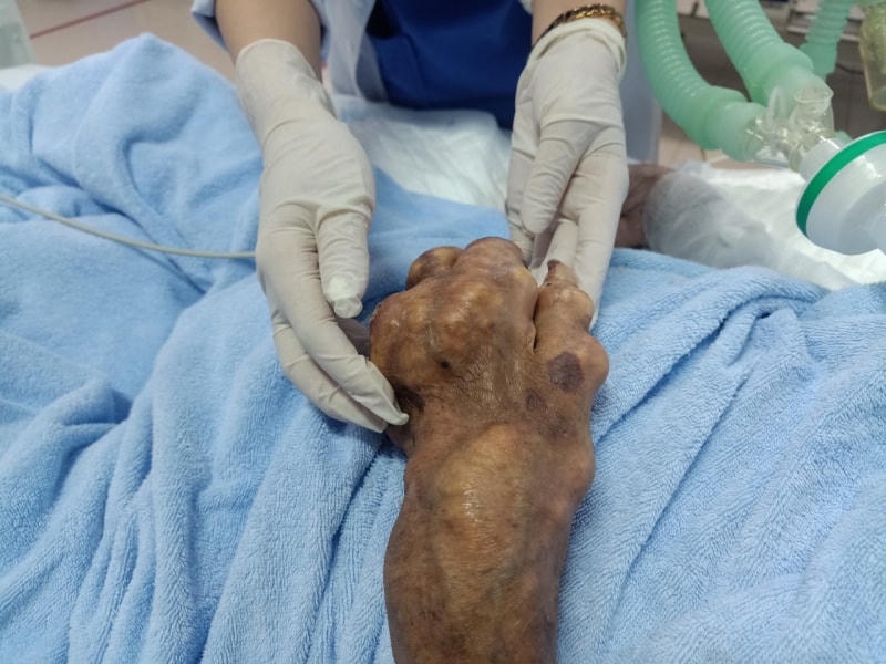 Bệnh nhân gout bị biến chứng.  