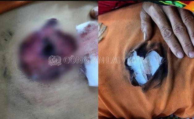 Chị M. bị bắn thương ở bụng. Ảnh: Công an Lai Châu
