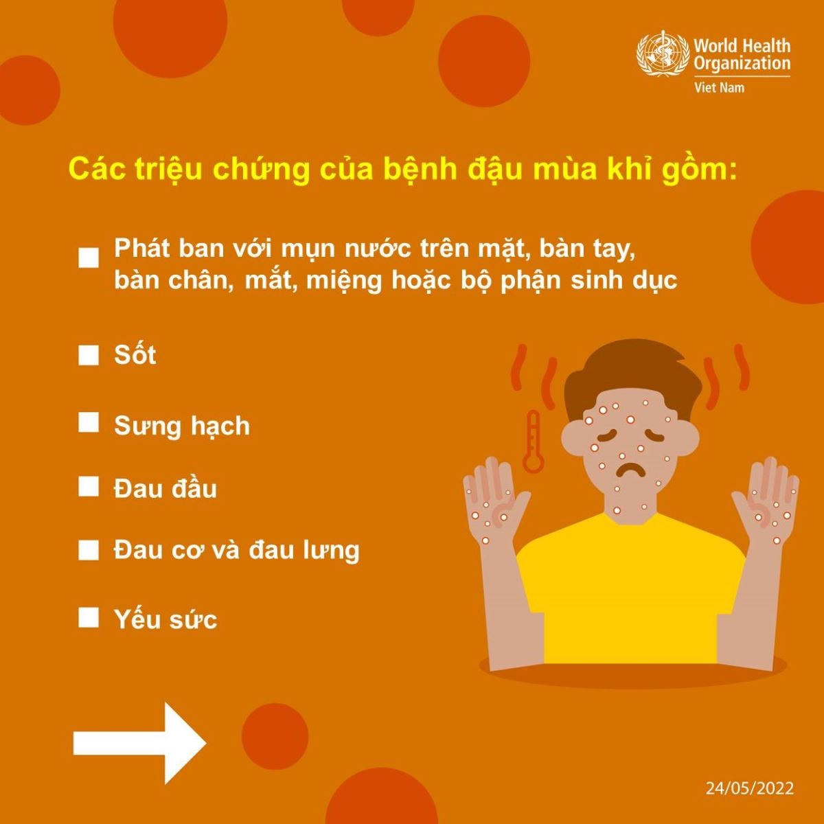 WHO cập nhật cẩm nang về bệnh đậu mùa khỉ