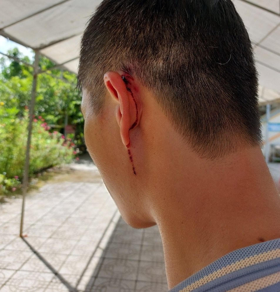 Ông M. bị Bí thư Chi bộ thôn 3 dùng xà beng đánh vào đầu, chảy máu.
