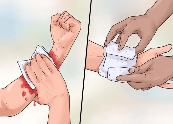 Xử lý vết thương khi bị chó cắn hoặc mèo cắn.